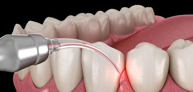 laser gum treatment