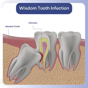 Wisdom Tooth Infection